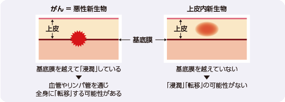 「がん(悪性新生物)」と「上皮内新生物」の違い(例:子宮頚部)
