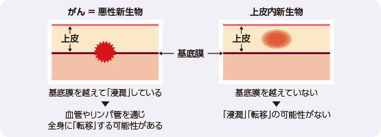 がん=悪性新生物 基底膜を越えて「浸潤」している 血管やリンパ管を通じ全身に「転移」する可能性がある 上皮内新生物 基底膜を越えていない 「浸潤」「転移」の可能性がない