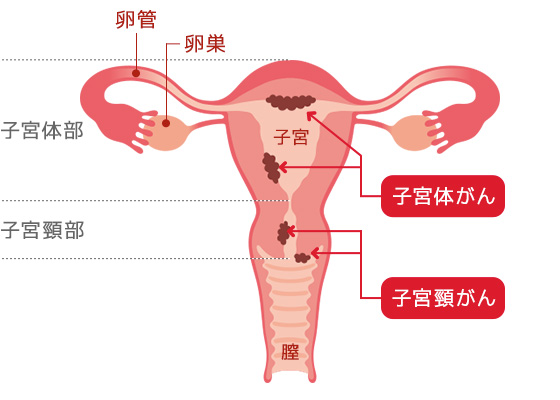 子宮頸がん 早期発見のために検診を 保険 生命保険はアフラック