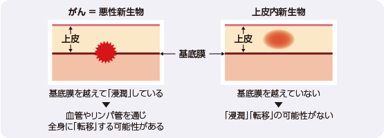 「がん（悪性新生物）」と「上皮内新生物」の違い（例：子宮頚部）