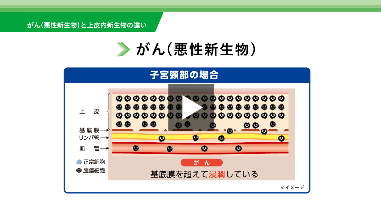 がん（悪性新生物）と上皮内新生物の違い がん（悪性新生物） 子宮頸部の場合 上皮 基底膜 リンパ管 血管 正常細胞 腫瘍細胞 がん 基底膜を超えて浸潤している ※イメージ